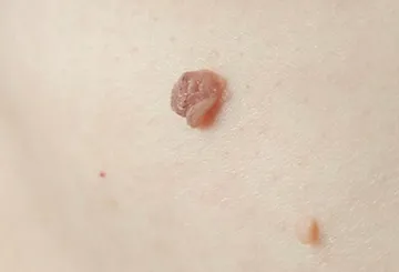 skin tags removal